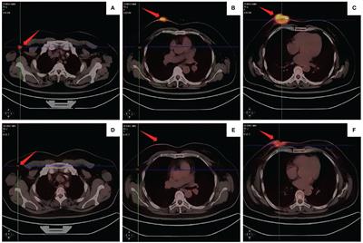 Disitamab Vedotin (RC48) for HER2-positive advanced breast cancer: a case report and literature review